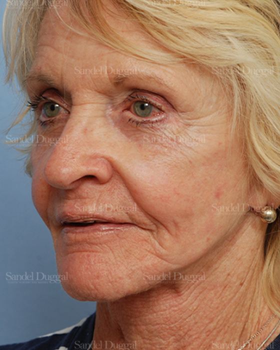 Cheek Augmentation after, case 1446