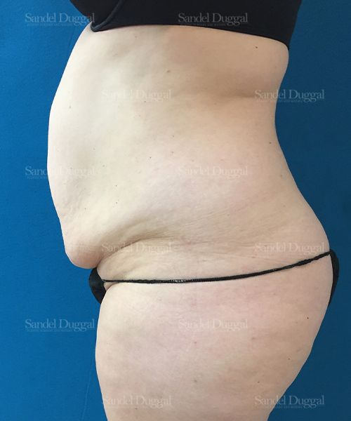 Tummy Tuck before, case 1673