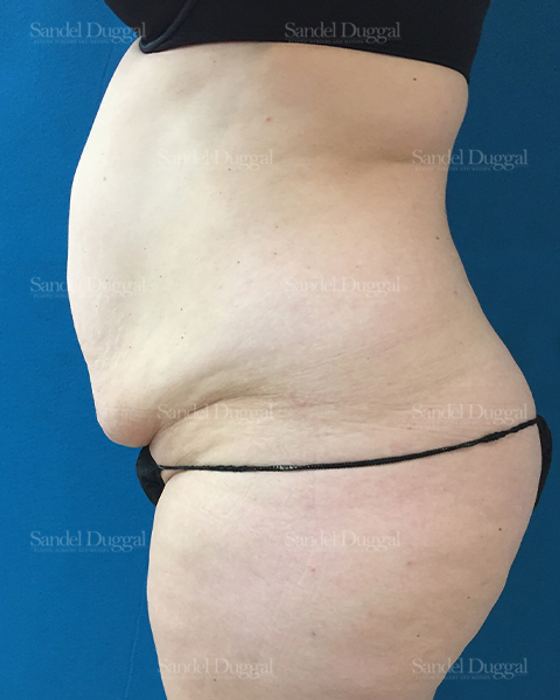 Tummy Tuck before, case 1673