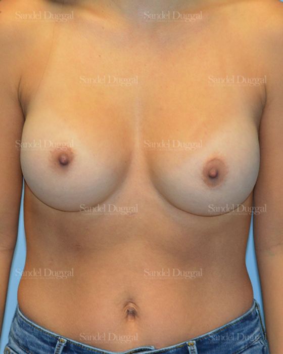 Breast Augmentation after, case 3234