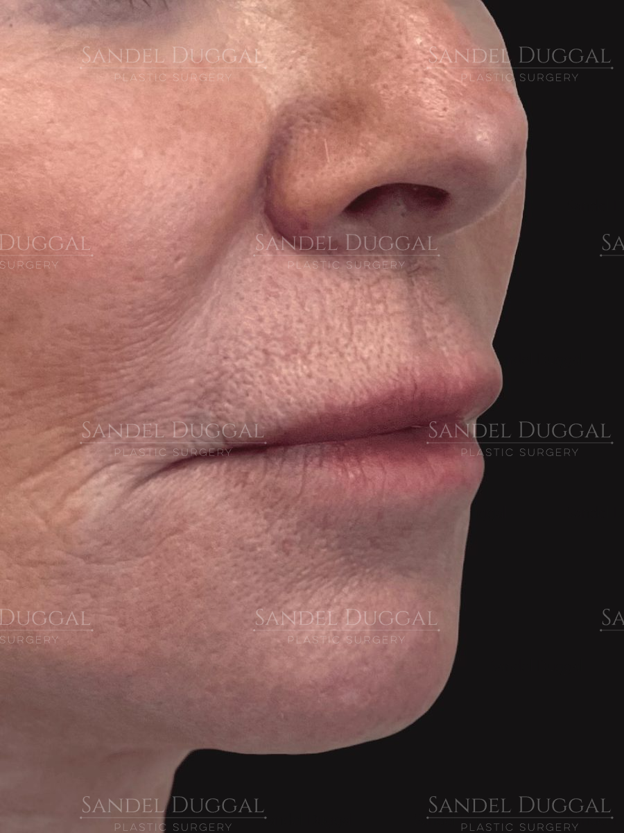 Subnasal Lip Lift before, case 6004