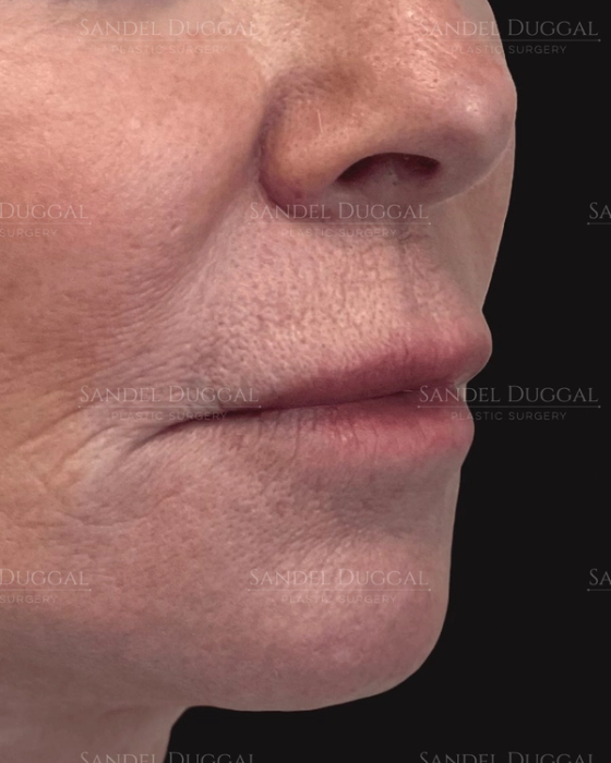Subnasal Lip Lift before, case 6004