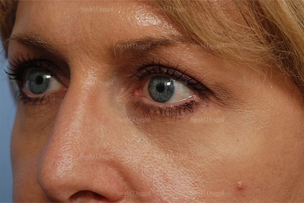 Eyelid Rejuvenation after, case 824