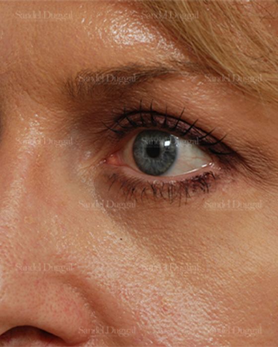 Eyelid Rejuvenation after, case 824