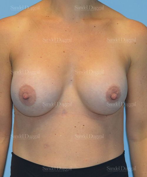 Breast Augmentation after, case 3115
