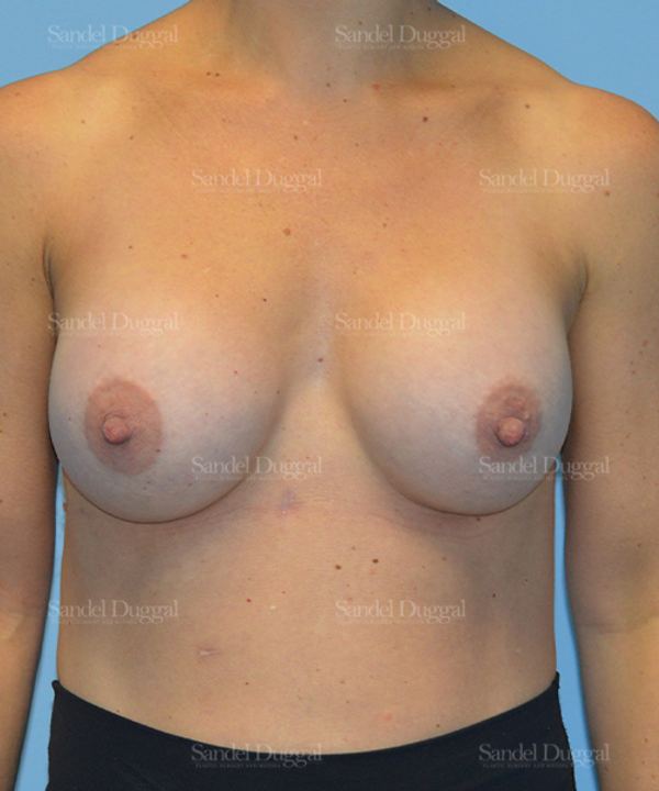Breast Augmentation after, case 3115