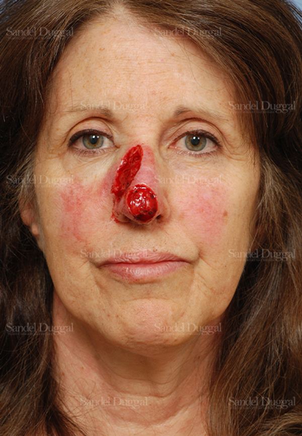 Reconstruction after Mohs before, case 2793