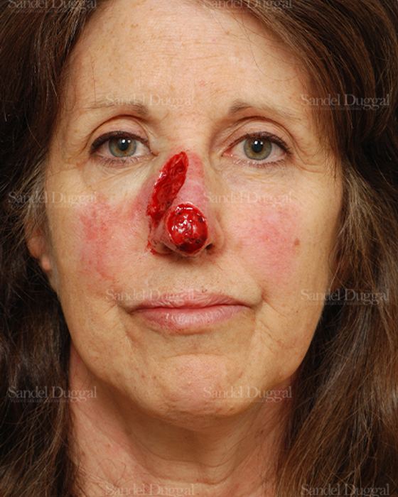 Reconstruction after Mohs before, case 2793