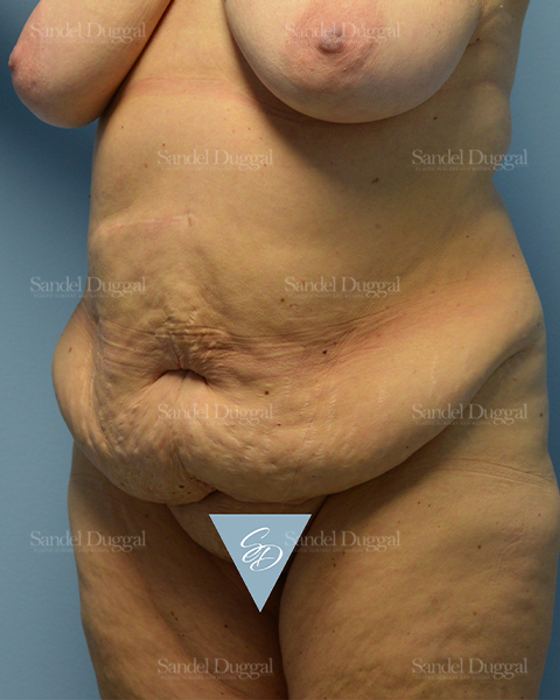 Tummy Tuck before, case 1566