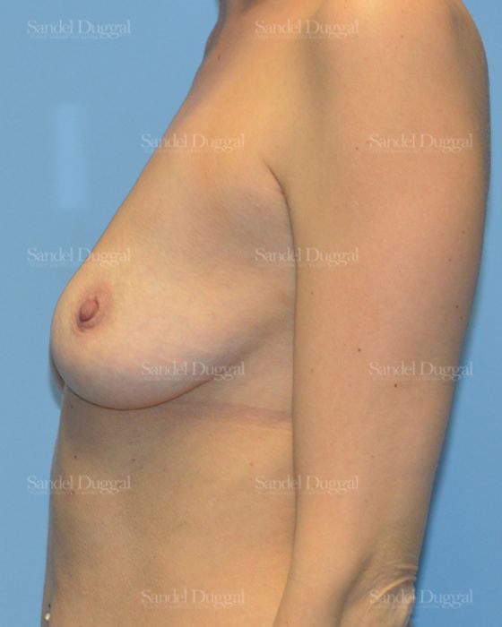 Breast Augmentation with Lift before, case 3358