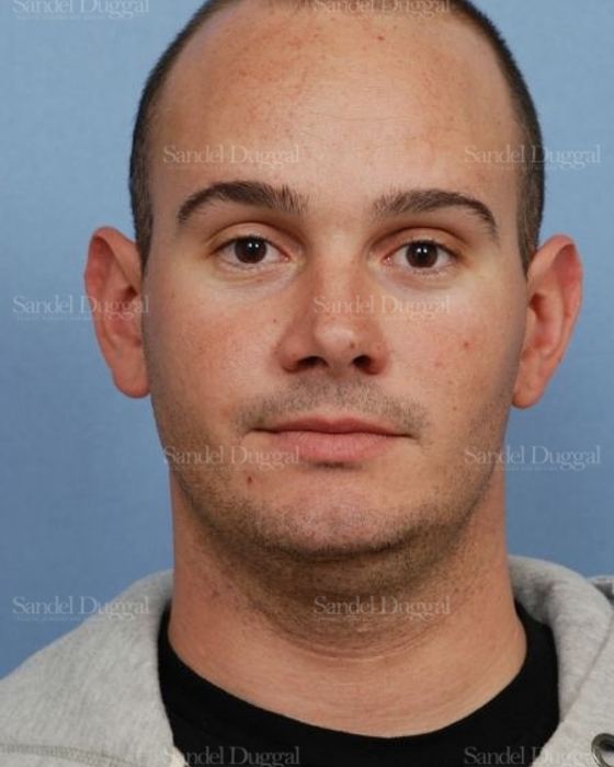 Otoplasty before, case 4068