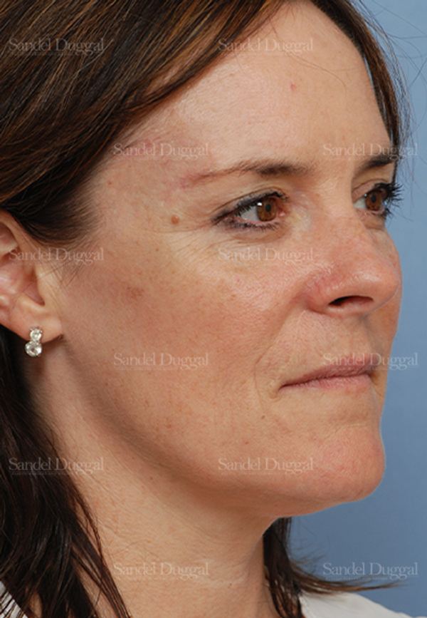 Reconstruction after Mohs after, case 2760