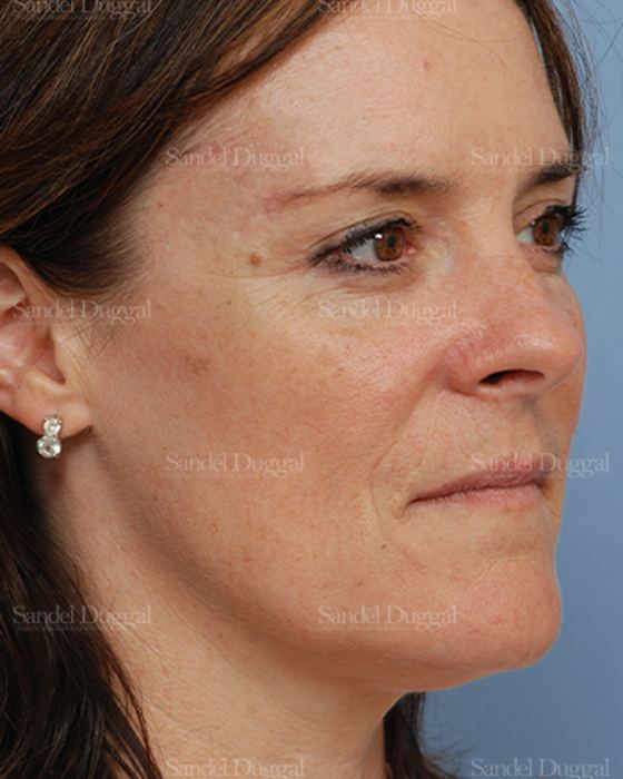 Reconstruction after Mohs after, case 2760