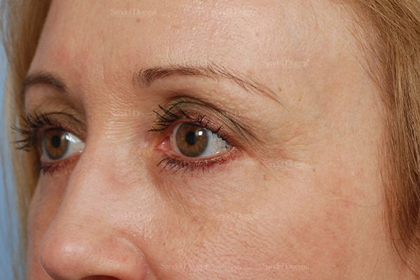 Eyelid Rejuvenation after, case 1917