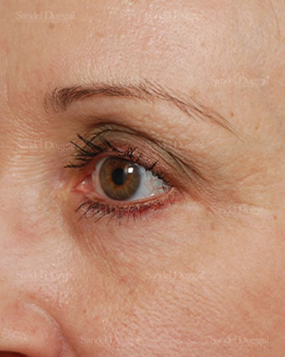 Eyelid Rejuvenation after, case 1917