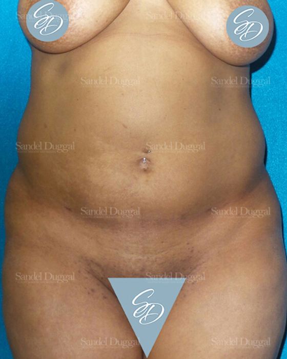 Liposuction — Abdomen before, case 2456