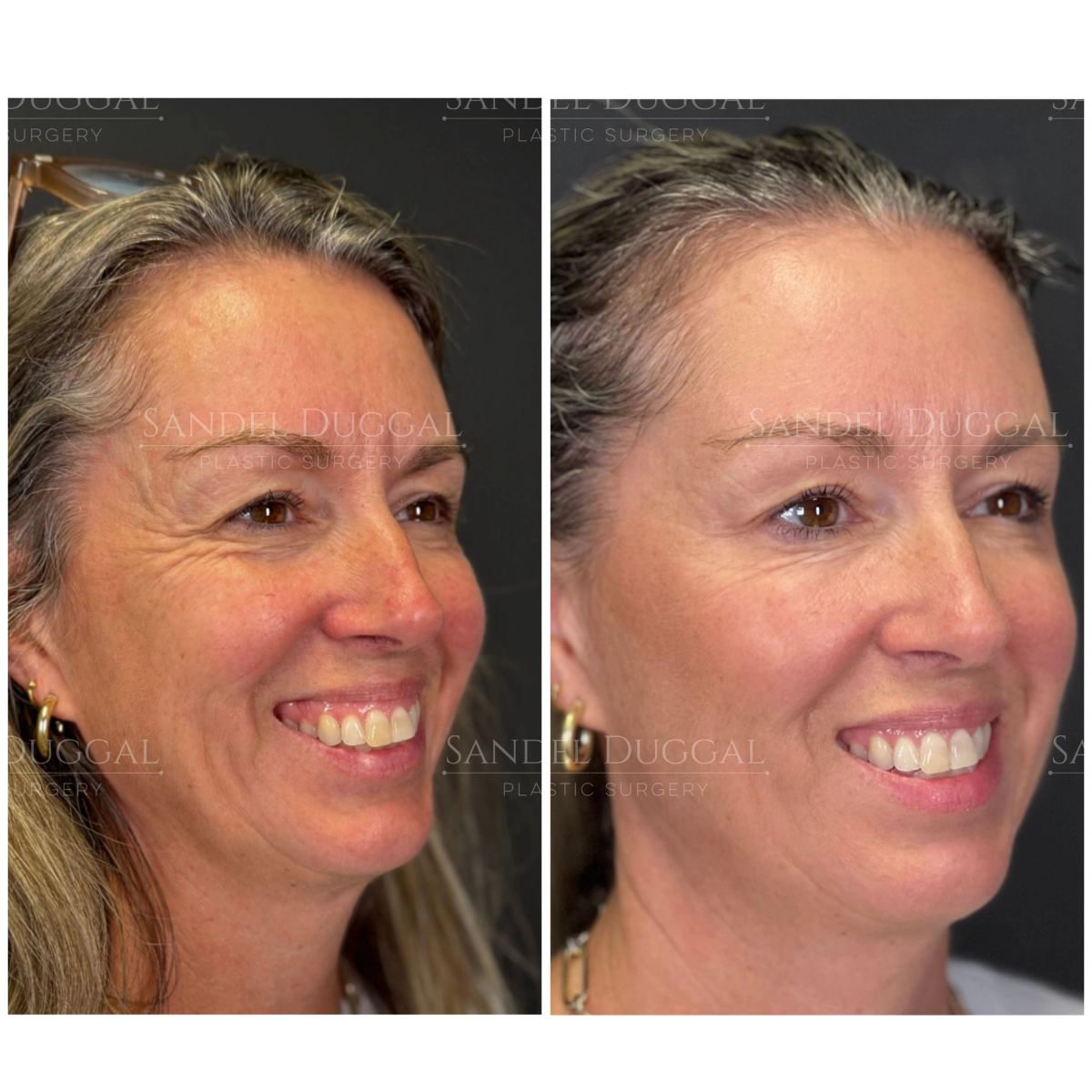 Botox & Fillers before and after, case 6008