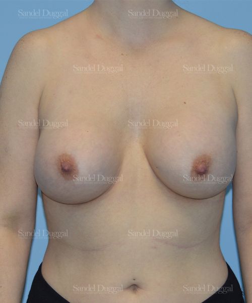 Breast Augmentation after, case 3066