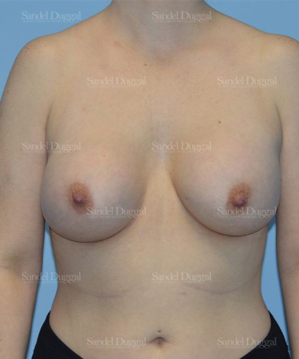 Breast Augmentation after, case 3066