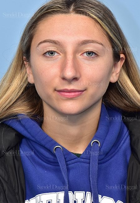 Rhinoplasty before, case 5375
