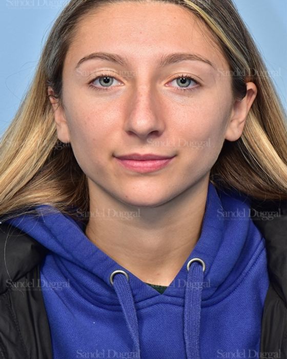 Rhinoplasty before, case 5375