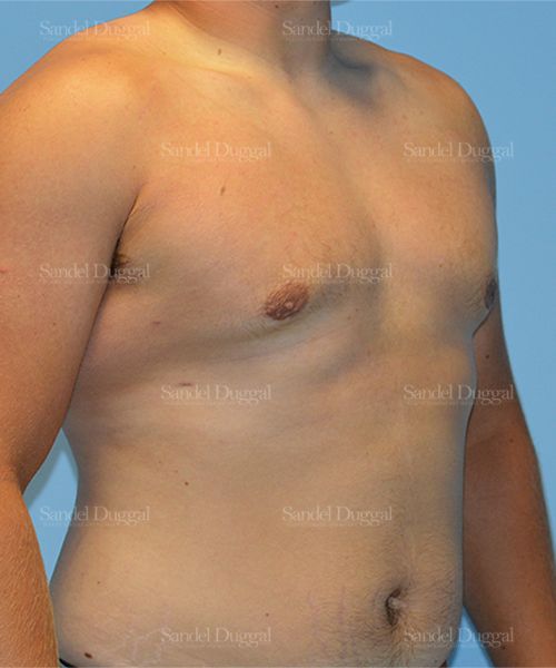 Gynecomastia after, case 1454