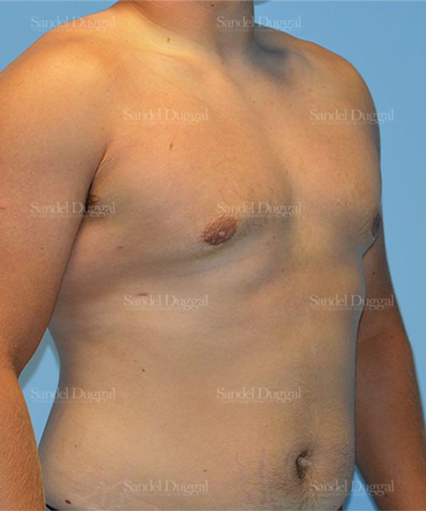 Gynecomastia after, case 1454