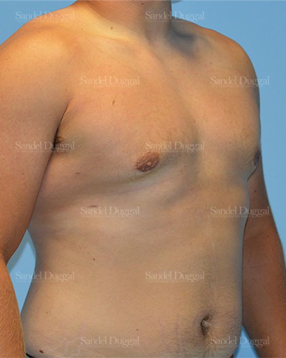 Gynecomastia after, case 1454