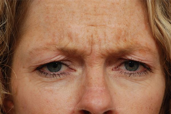 Botox & Fillers before, case 845