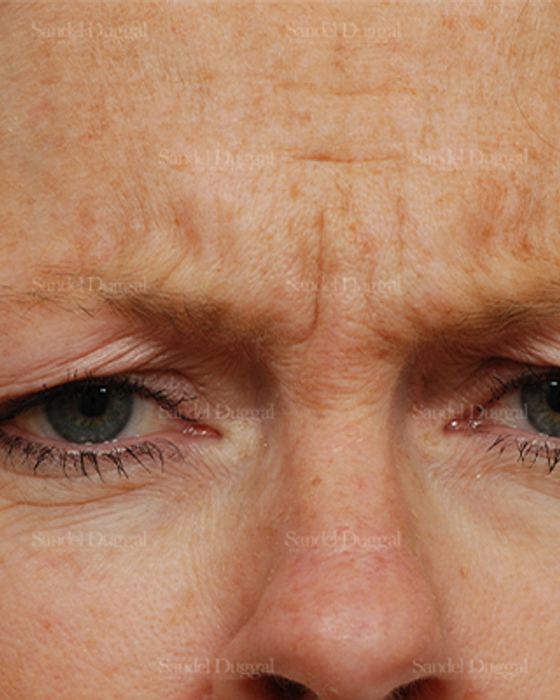 Botox & Fillers before, case 845