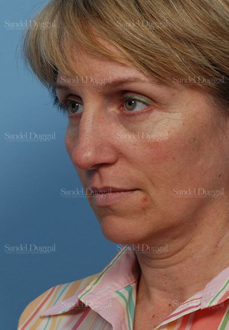 Rhinoplasty before, case 2855