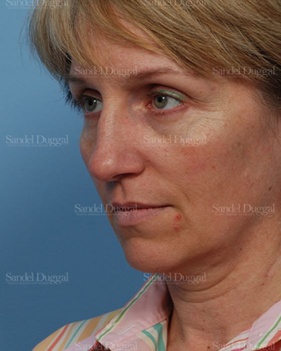 Rhinoplasty before, case 2855