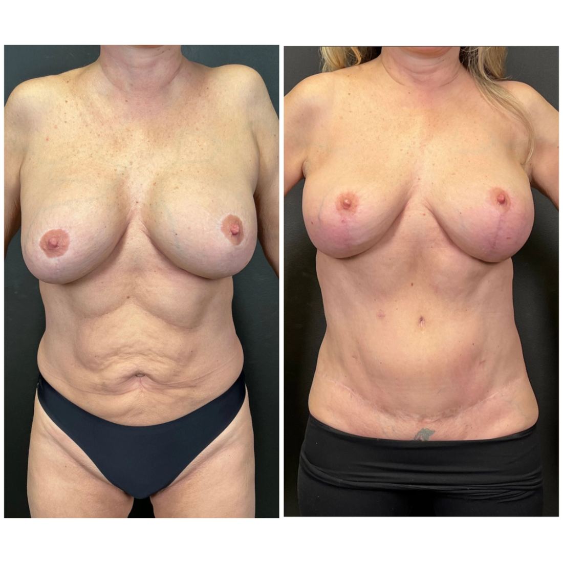 Mommy Makeover before and after, case mommy-makeover-01