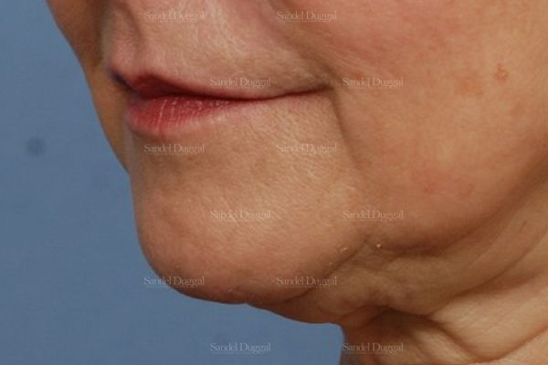 Pre-Jowl Implant before, case 2594