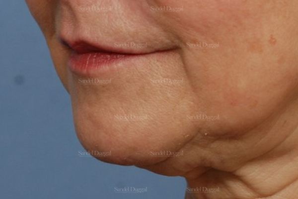 Pre-Jowl Implant before, case 2594
