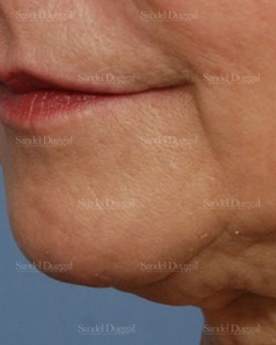 Pre-Jowl Implant before, case 2594