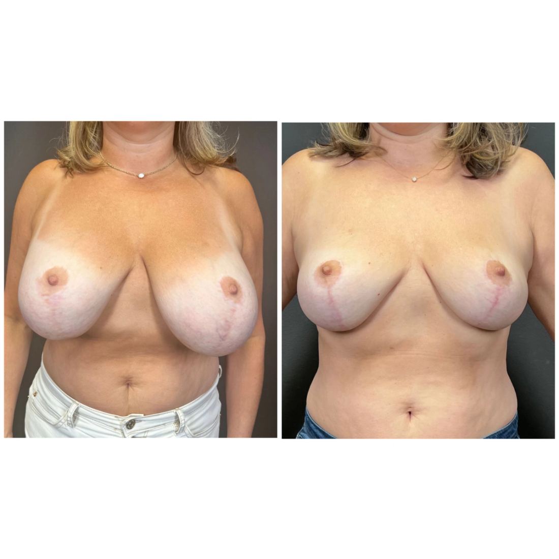 Breast Lift before and after, case breast-lift-new-08