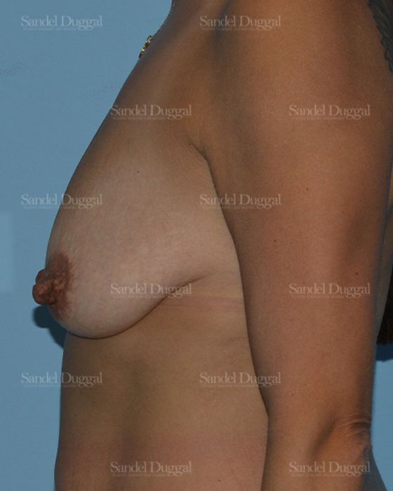 Breast Augmentation with Lift before, case 3449