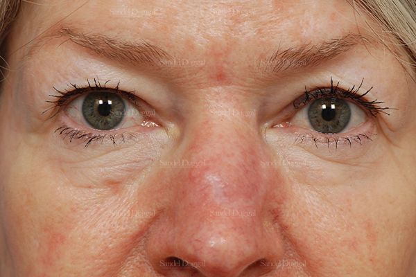 Eyelid Rejuvenation before, case 1912