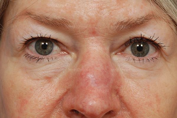 Eyelid Rejuvenation before, case 1912