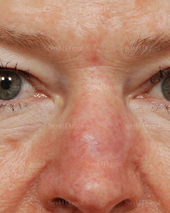 Eyelid Rejuvenation before, case 1912