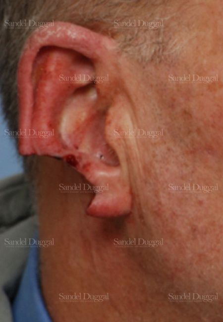 Reconstruction after Mohs before, case 2736