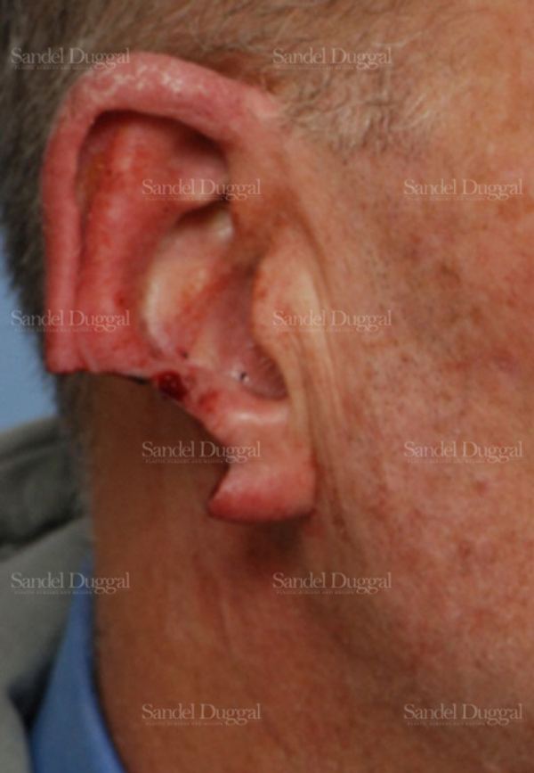Reconstruction after Mohs before, case 2736