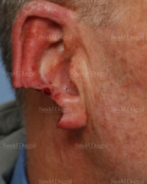 Reconstruction after Mohs before, case 2736