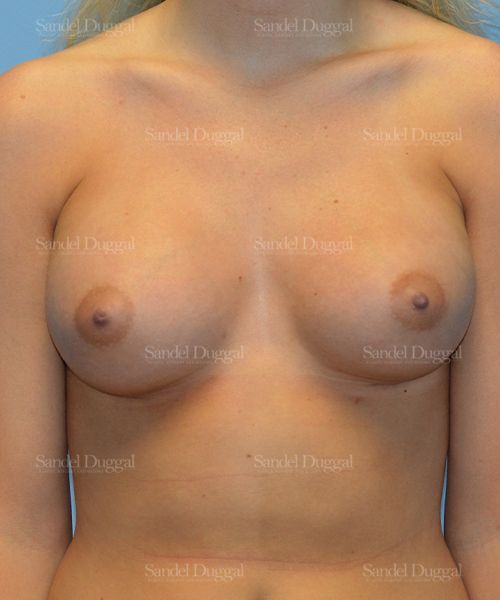 Breast Augmentation after, case 3080