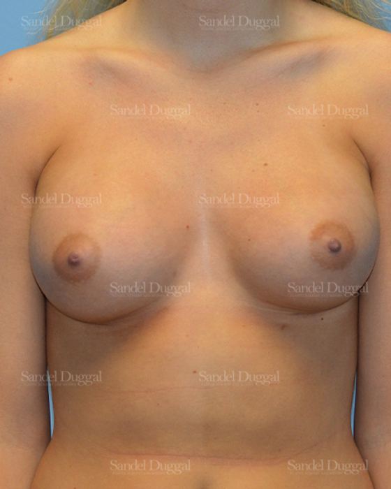 Breast Augmentation after, case 3080