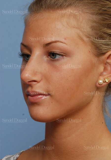 Rhinoplasty after, case 2876