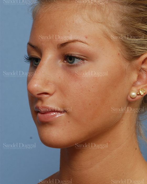 Rhinoplasty after, case 2876