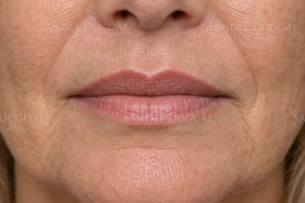 Lip Filler after, case 6015