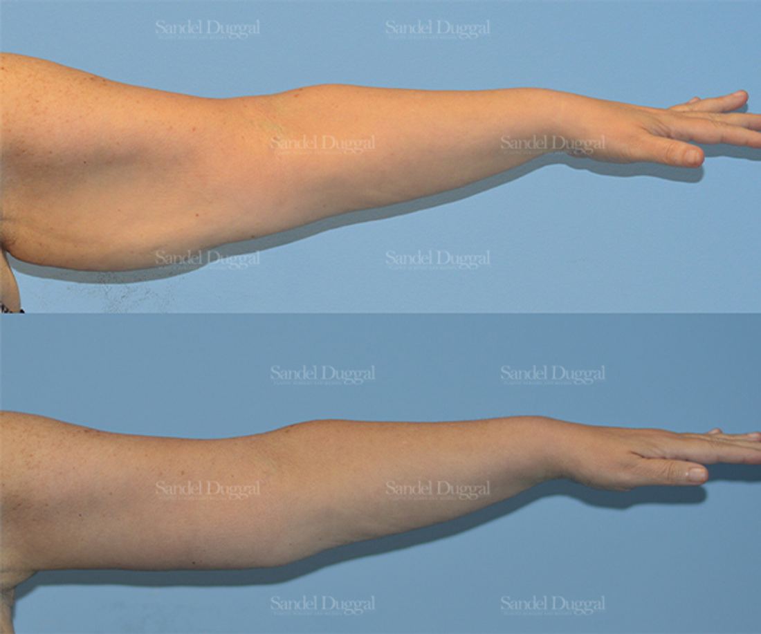 Brachioplasty before and after, case 2108